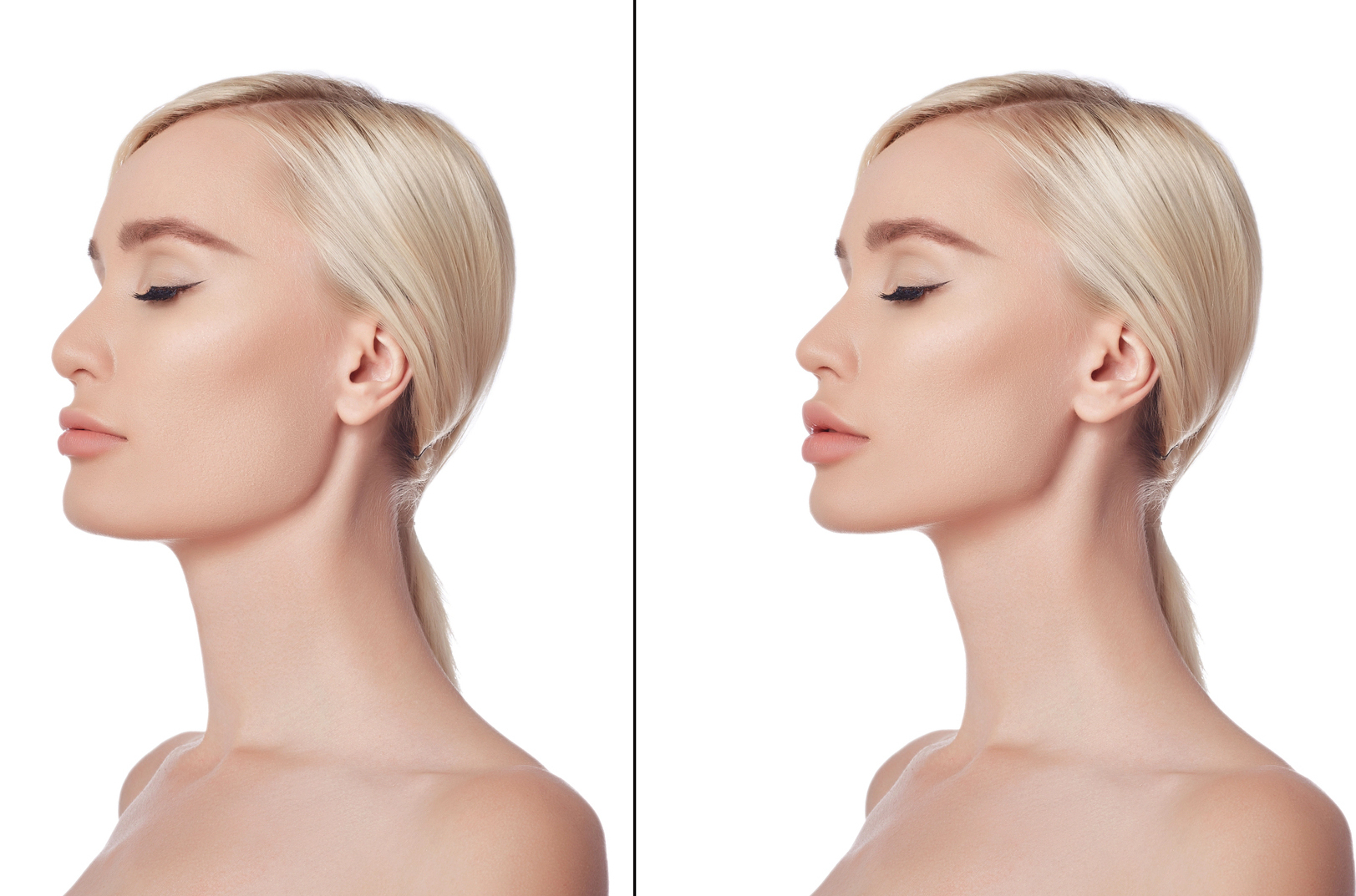 Remodelage du menton